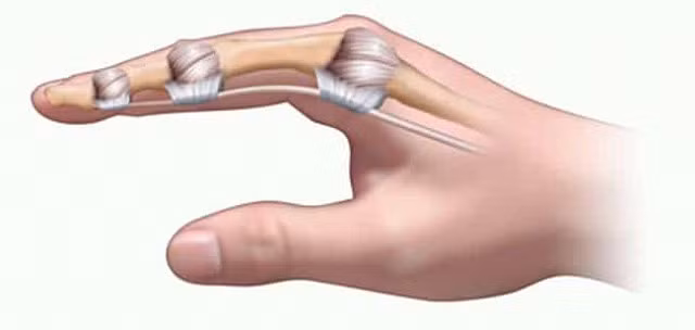 Cách chính xác nhất phân biệt bong gân cổ tay và gãy xương cổ tay để xác định cần phải nhập viện hay không - Hình 2