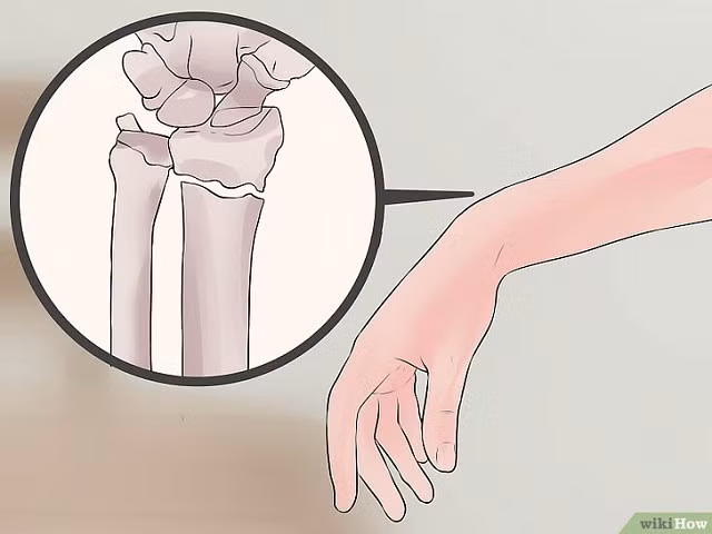 Cách chính xác nhất phân biệt bong gân cổ tay và gãy xương cổ tay để xác định cần phải nhập viện hay không - Hình 1