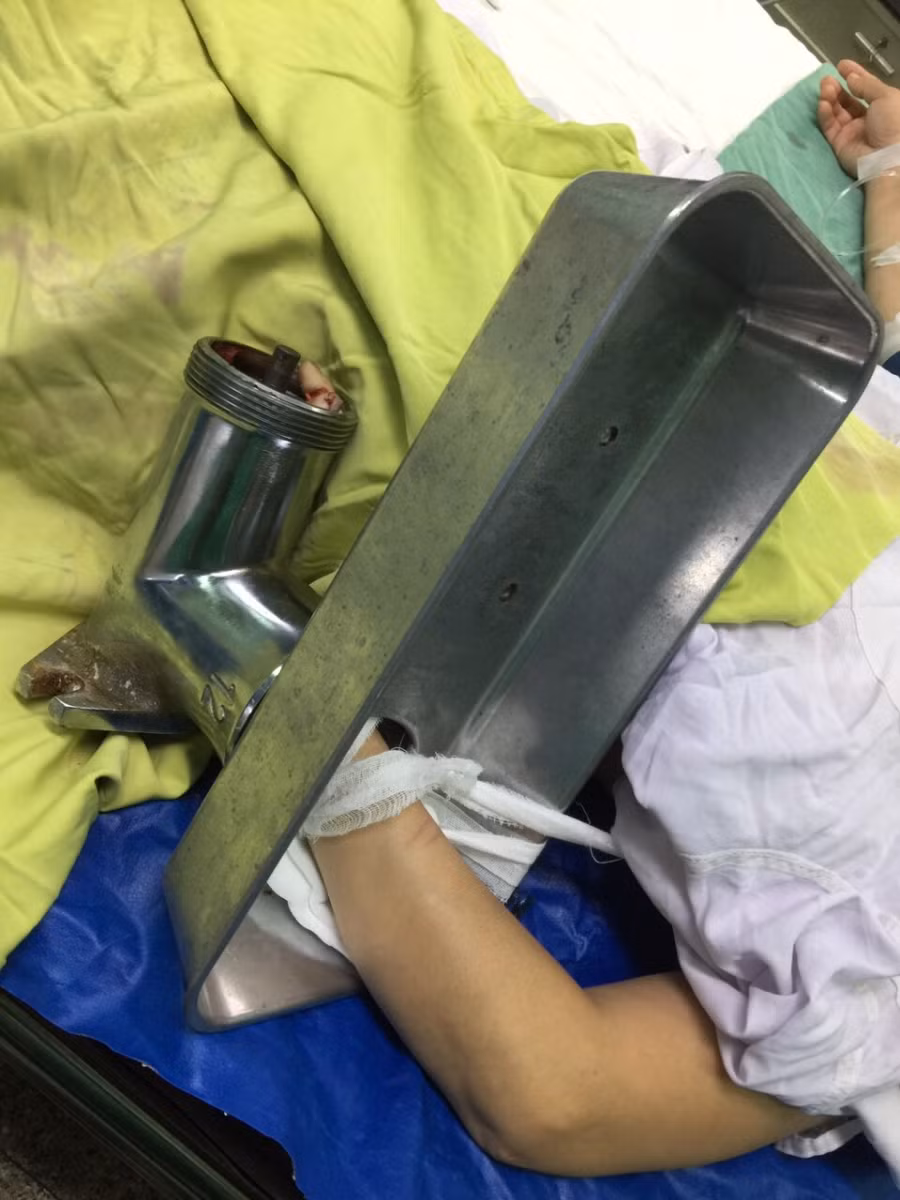 Hình ảnh bàn tay trái của bệnh nhân bị cuốn vào máy xay thịt.