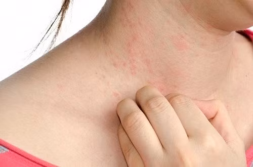 Những người đại kỵ với trai, hến, đừng ăn kẻo “hối không kịp“