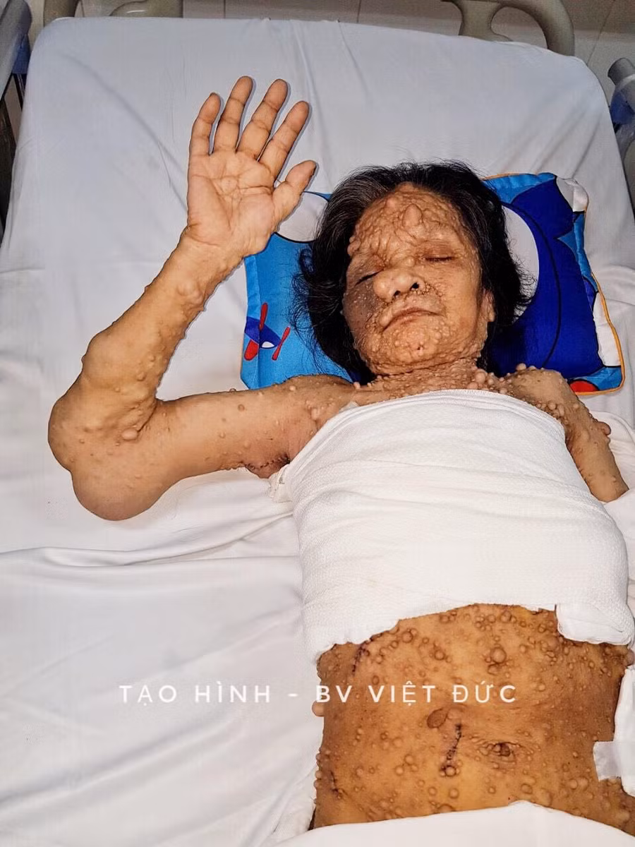 Kinh hoàng người phụ nữ mọc u toàn thân chi chít như quả sung - Ảnh 3.