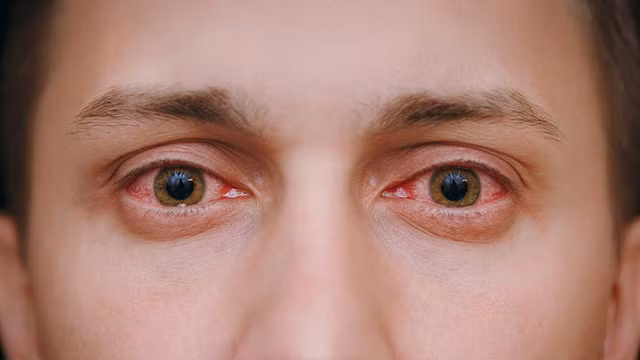 Làm gì khi có hiện tượng đỏ mắt? ảnh 1