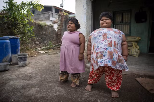 Trước đây, tổng cân nặng của hai bé gái lên tới 22 stone (gần 140 kg)