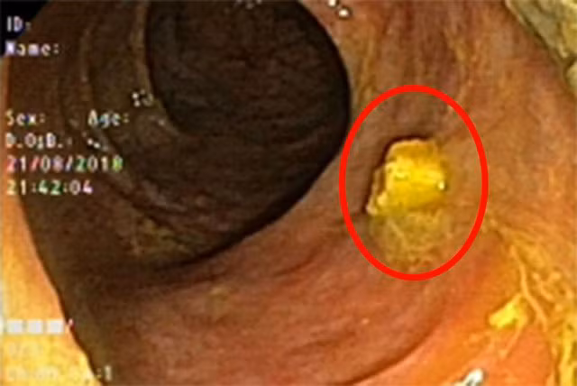 Dị vật là 2 chiếc răng giả và mấu kim loại được lấy ra từ đường tiêu hóa người bệnh
