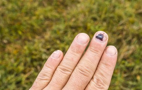 Móng tay bầm tím không rõ nguyên nhân, bác sĩ mãi không thể lý giải cho đến khi xét nghiệm-3