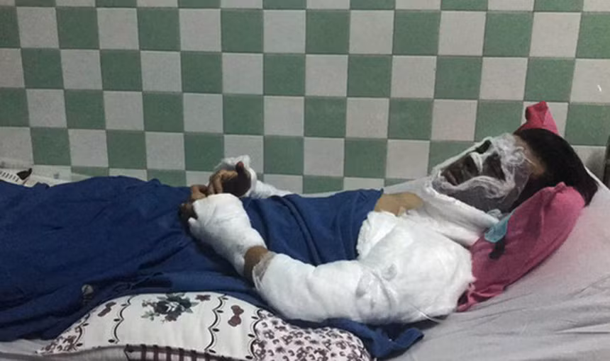 Viet kieu bi tat axit ngay Tet: Doi mat bi ton thuong nang hinh anh 1