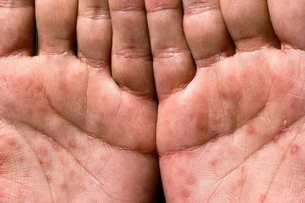 Trong giai đoạn thứ hai của bệnh, ban đỏ xuất hiện trên bất kỳ vùng nào trên cơ thể, trong đó có lòng bàn tay, bàn chân. Dấu hiệu cảnh báo bệnh giang mai đang tiềm ẩn trong bạn
