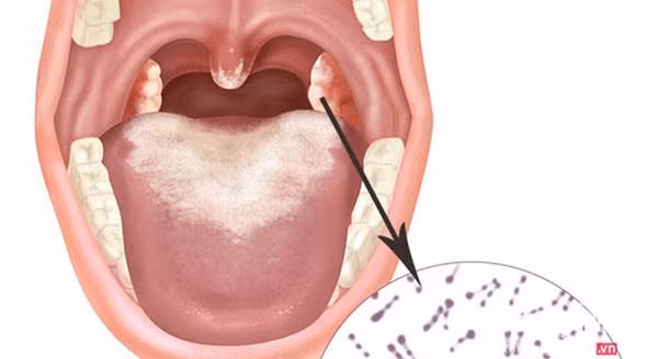 Những điều cần biết về bạch hầu - căn bệnh có thể gây tử vong trong 6 ngày-1