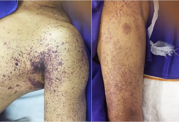  Bệnh nhân nhiễm liên cầu khuẩn lợn bị ban xuất huyết hoại tử rải rác khắp cơ thể 