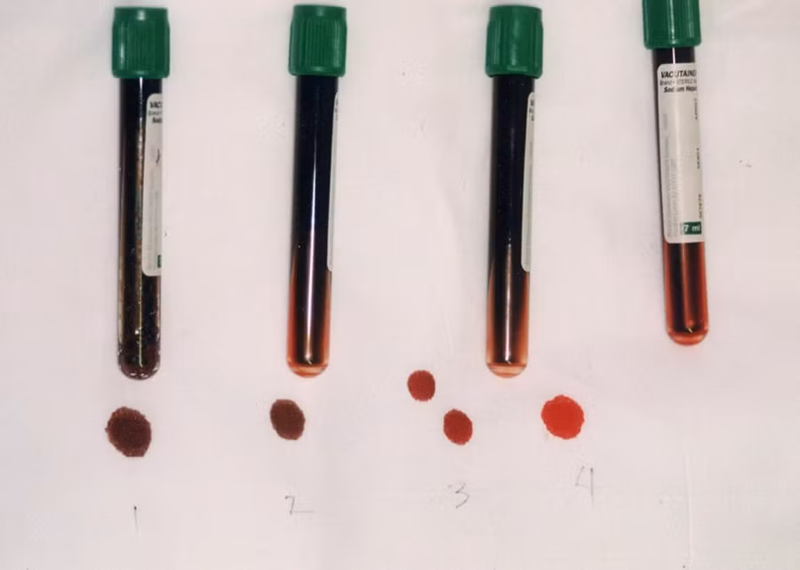 Trong ống 1 và 2, tỷ lệ methemoglobin là 70%; trong ống 3 là 20%; và trong ống 4 là bình thường. Trong ống 1 và 2, tỷ lệ methemoglobin là 70%; trong ống 3 là 20%; và trong ống 4 là bình thường.