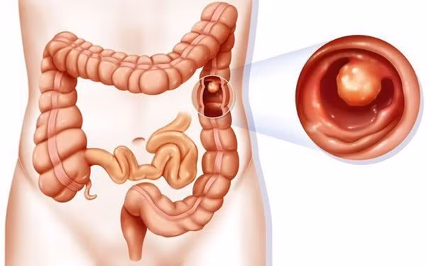 Loại đồ uống ưa thích gây ra 230 bệnh, 8 loại ung thư ở người Việt-3