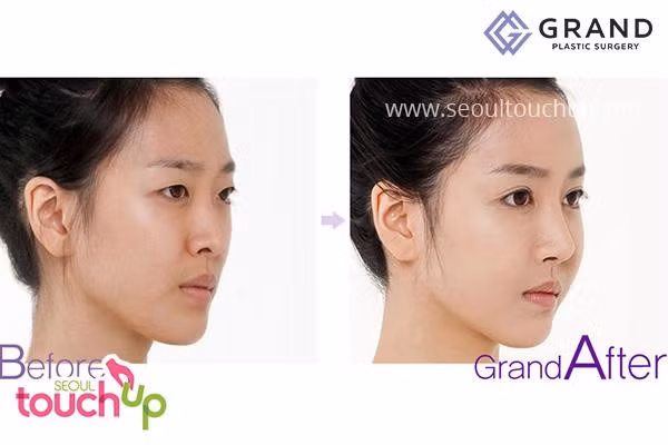 9 xu hướng phẫu thuật thẩm mỹ phổ biến nhất ở Hàn Quốc-4