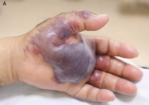 Bàn tay bị nhiễm trùng nặng do ăn hải sản sống của cụ ông Hàn Quốc. Ảnh: Asia One.