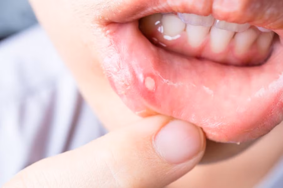 Mẹo hay chữa nhiệt miệng không cần dùng thuốc ảnh 1