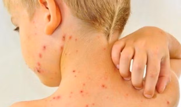 Cảnh báo: Bệnh sởi có dấu hiệu tăng đột biến ở Hà Nội