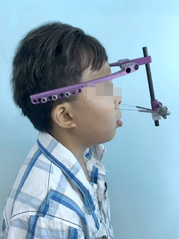 Dũng là bệnh nhi đầu tiên tại Việt Nam sử dụng khí cụ kéo giãn xương hàm để chỉnh hình khuôn mặt. Ảnh:N.P Dũng là bệnh nhi đầu tiên tại Việt Nam sử dụng khí cụ kéo dãn xương hàm để chỉnh hình khuôn mặt. Ảnh: N.P