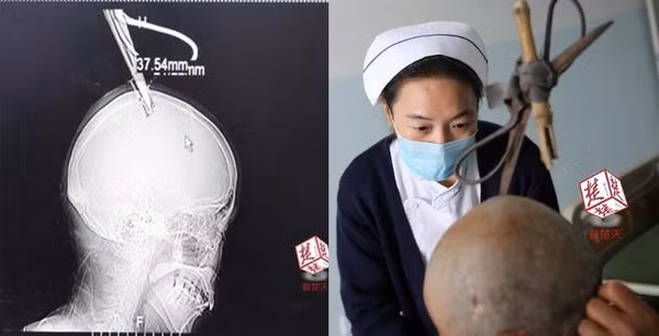 Cây kéo mắc kẹt trên đầu bà Trần và phim chụp X-quang cho thấy cây kéo suýt chạm vào não của bà