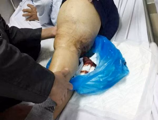 Bệnh máu khó đông benh mau kho dong