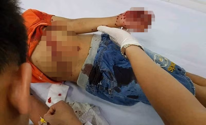 Pin đồ chơi phát nổ, bé trai nhoe nhoét vết thương