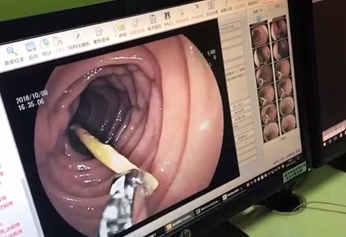 Chiếc đũa dài 7 cm trong bụng người phụ nữ Trung Quốc