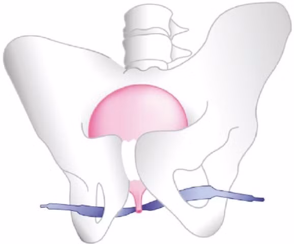 Bệnh són tiểu thường gặp ở phụ nữ sau sinh
