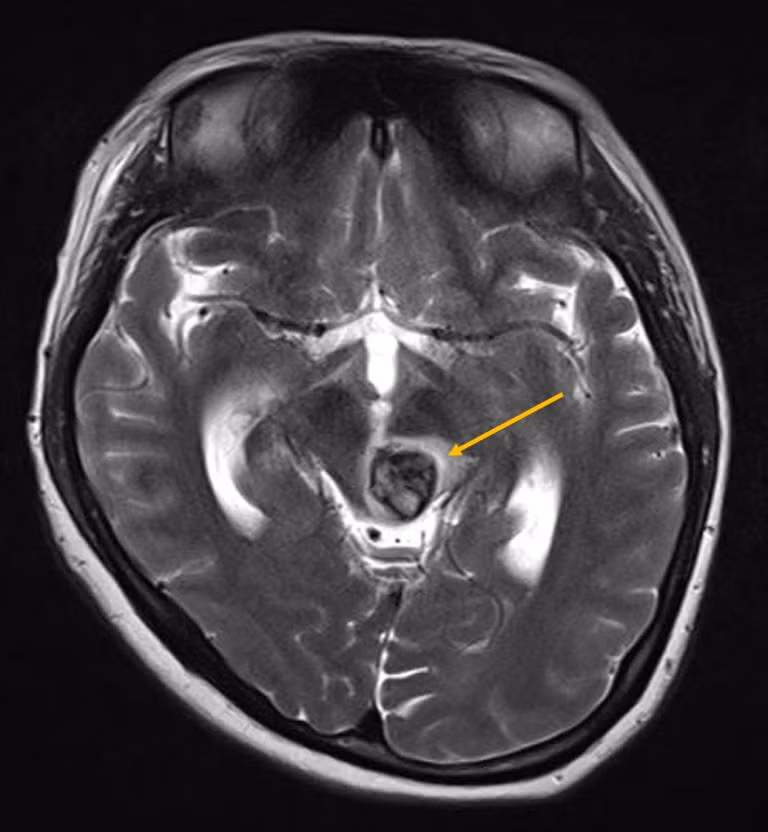 Kết quả chụp MRI cho thấy người bệnh có khối dị dạng mạch máu dạng hang rất hiếm gặp (Ảnh: BVCC).