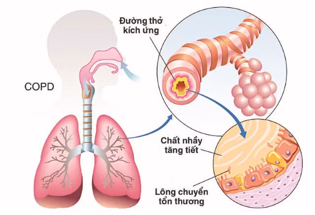 Bệnh phổi tắc nghẽn mạn tính: Có thể điều trị bằng ứng dụng tế bào gốc 