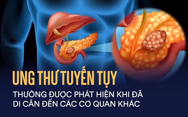 Bệnh ung thư tụy khó phát hiện, gây tử vong nhanh