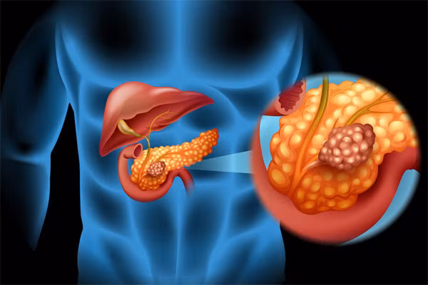 Tụy nằm ở giữa các mạch máu nên việc phẫu thuật nhiều khó khăn. Ảnh: Mskcc.