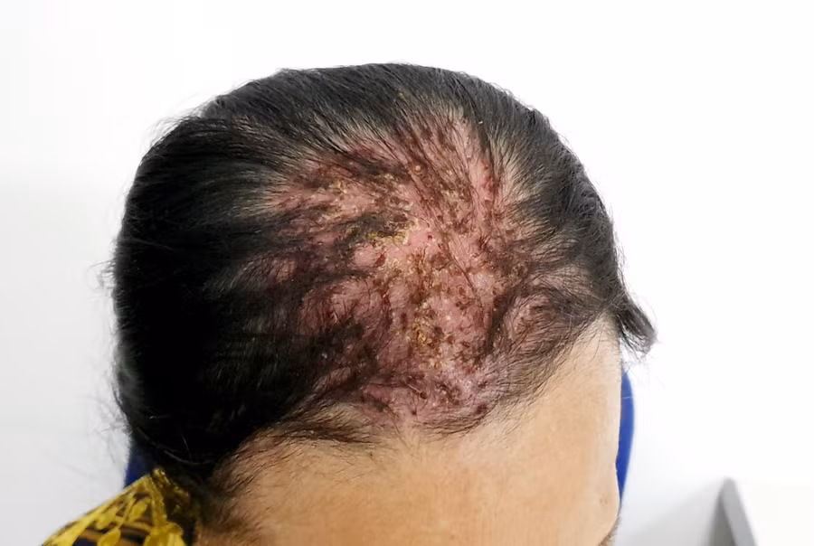 Điều trị ung thư bệnh nhân xuất hiện vấy trên đầu
