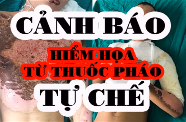 Sử dụng pháo tự chế, người đàn ông gãy xương vùng mặt và chi chít vết thương