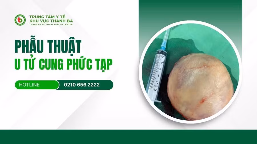 phau-thuat-khoi-u-tu-cung-phuc-tap-o-benh-nhan-51-tuoi.jpg