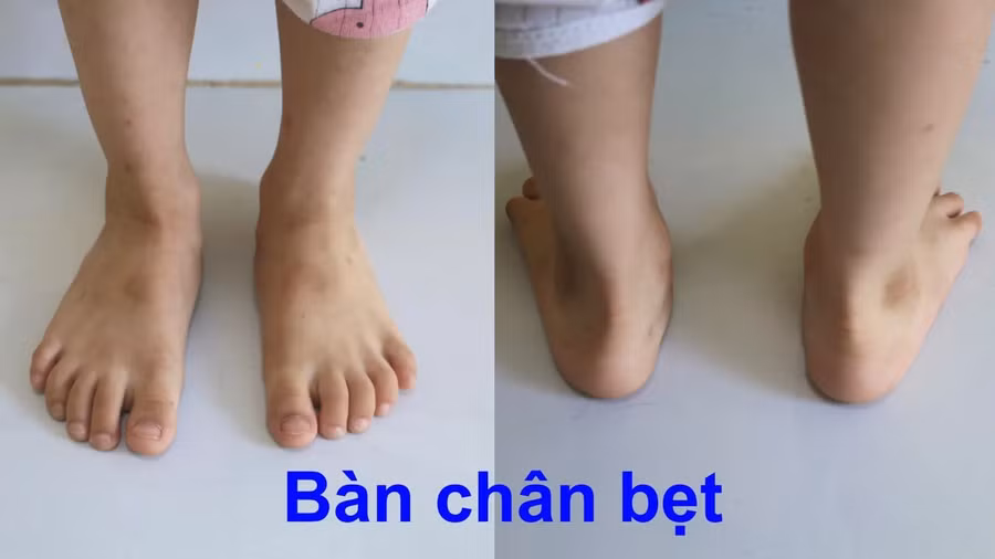 ban-chan-bet2.jpg