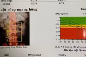 Kết quả đo loãng xương bằng phương pháp DEXA của một bệnh nhân bị biến chứng loãng xương do tự ý dùng corticoid kéo dài. Ảnh: BVCC