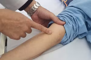 Ban xuất huyết hoại tử trên da bệnh nhân. Ảnh: Bệnh viện Bạch Mai cung cấp