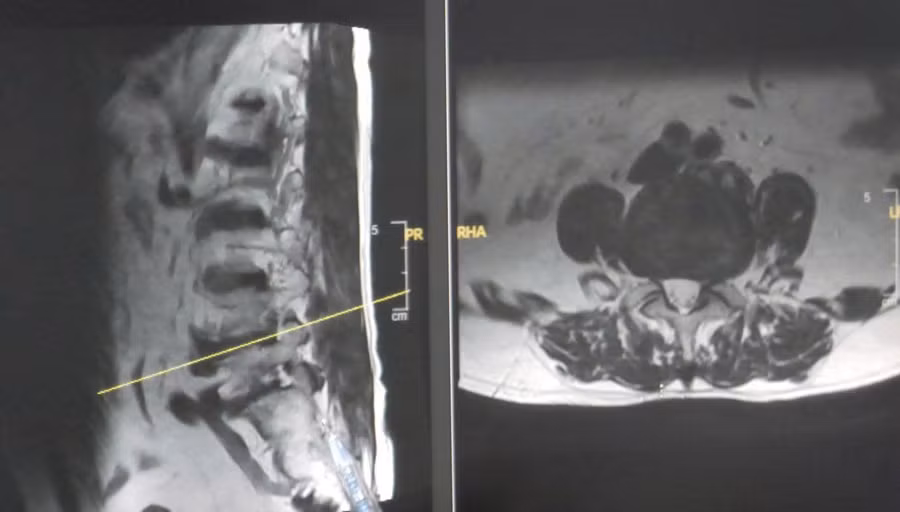 hinh-anh-mri-thoat-vi-dia-dem.jpg