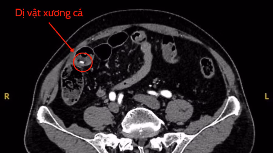 hinh-ct-bung1-2880.jpg