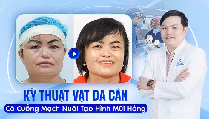 Sửa mũi hỏng tạo hình cánh mũi bằng kỹ thuật vạt da cân có cuống mạch nuôi