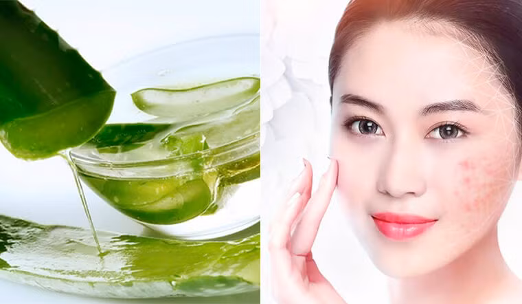 Thần dược tự nhiên trị mụn, chị em nào cũng cần 