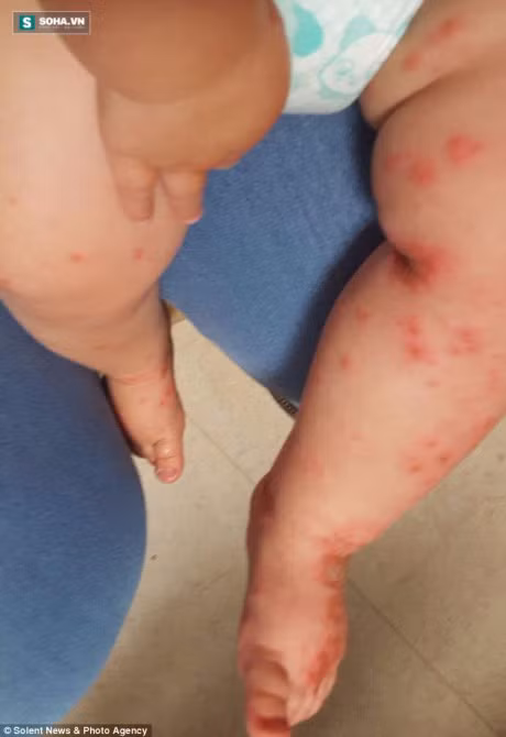 14 thang tuoi bi nhiem virus Herpes ca doi do nu hon tu nguoi lon - Anh 2