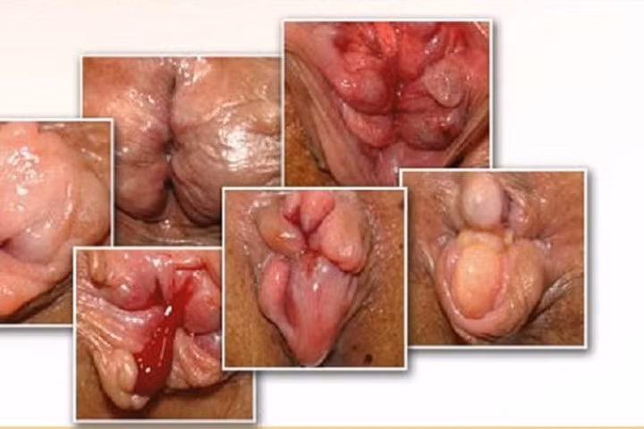 Mẹo chữa bệnh trĩ tại nhà