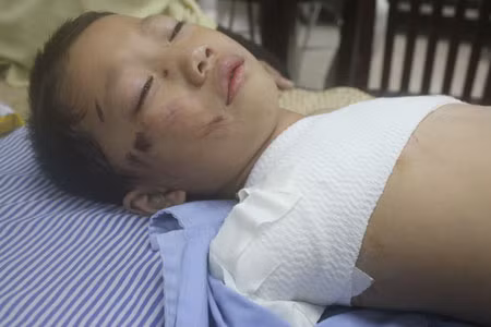 Bé 5 tuổi bị gấu nuôi cắn nát 2 tay 1 Bé 5 tuổi bị gấu nuôi cắn nát 2 tay 1