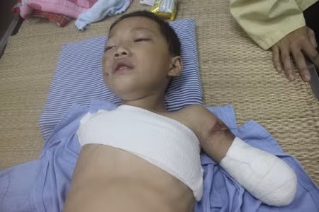 Bé 5 tuổi bị gấu nuôi cắn nát 2 tay 2 Bé 5 tuổi bị gấu nuôi cắn nát 2 tay 2