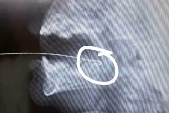 Hình ảnh X-quang của bệnh nhi. 