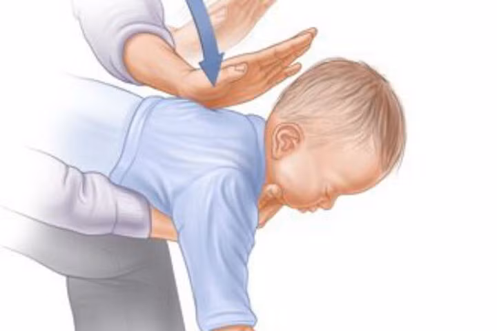 Cận cảnh sơ cứu trẻ hóc dị vật "đúng chuẩn" do bác sĩ BV Bạch Mai hướng dẫn