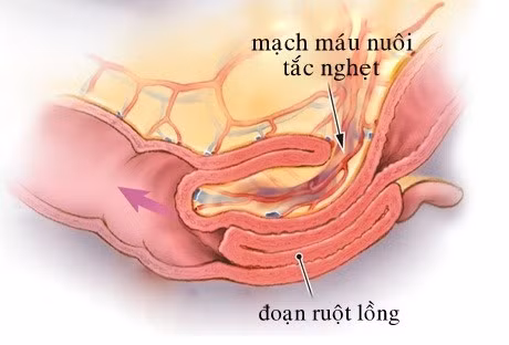 Cach phat hien va ngan ngua long ruot o tre - Anh 1