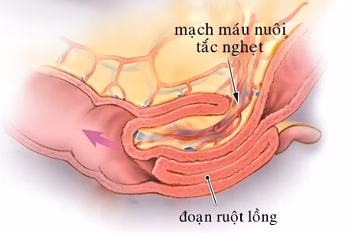 Cách phát hiện và ngăn ngừa lồng ruột ở trẻ