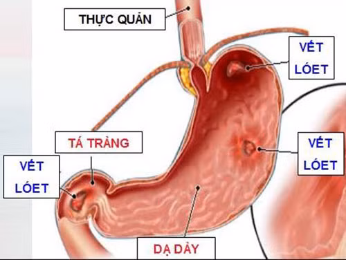 Những lưu ý quan trọng khi bị viêm loét dạ dày