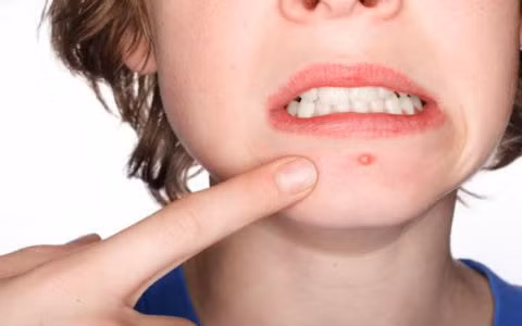 Mụn trứng cá xuất hiện do chế độ ăn uống mất cân đối