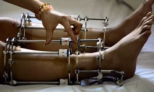 Hệ thống kéo dài chi lắp trên đôi chân một cô gái Ấn Độ. Ảnh: AP khat-vong-chan-dai-cua-thanh-nien-an-do